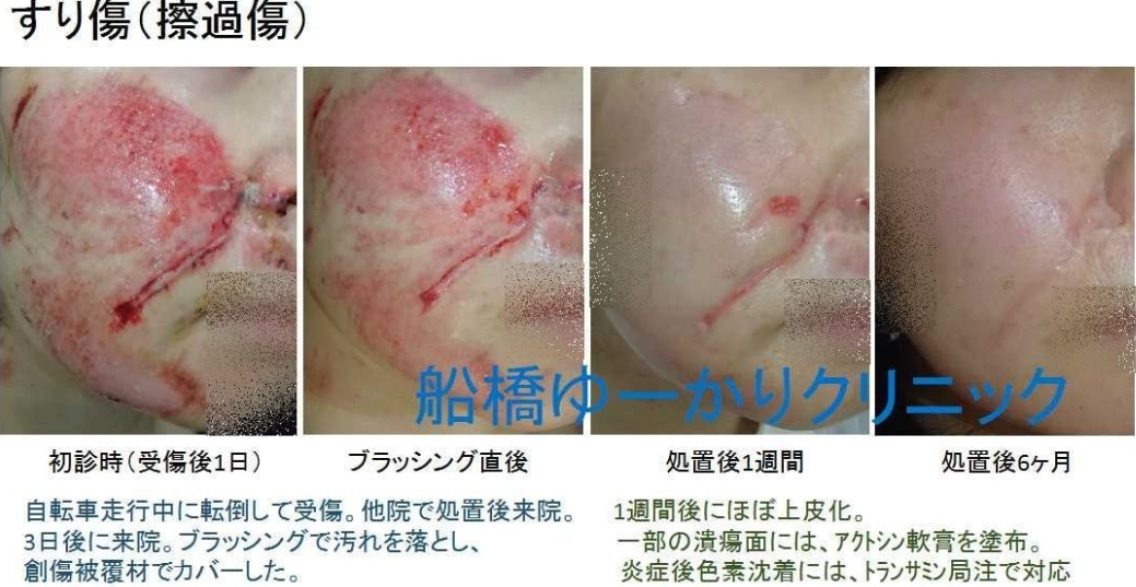 擦過傷重症例1