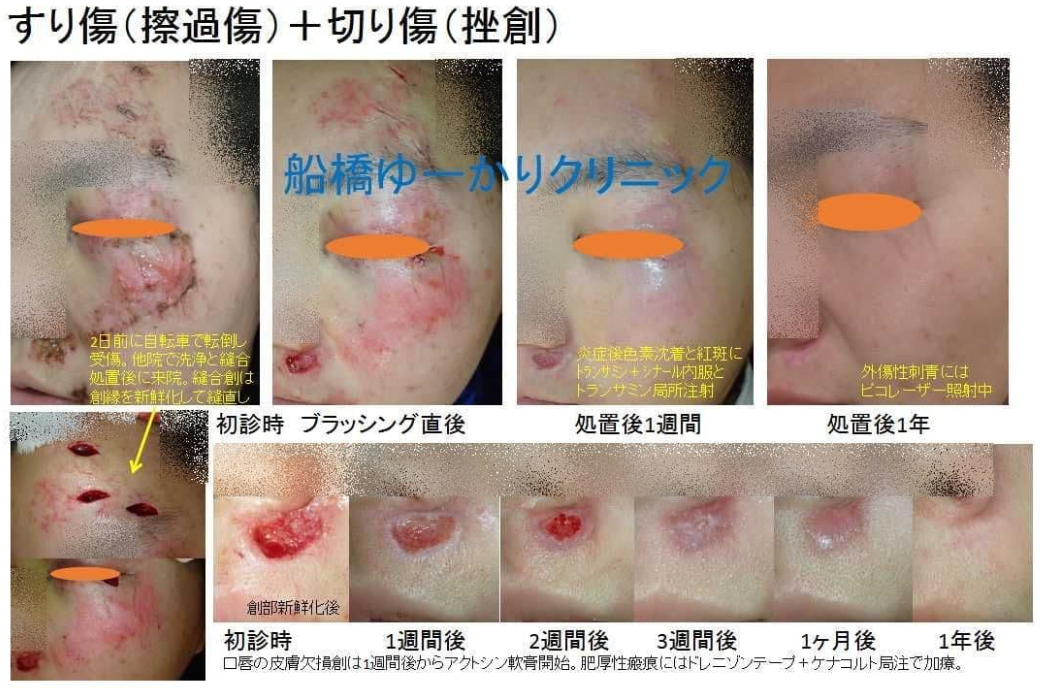 擦過傷重症例3