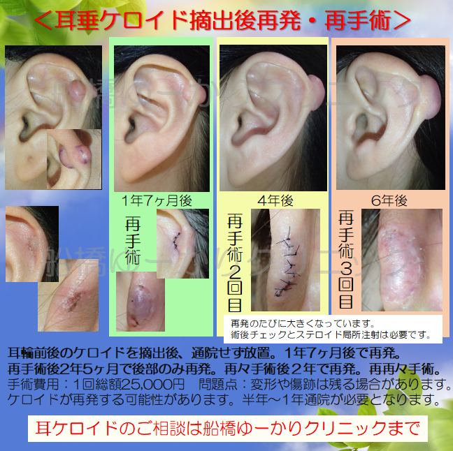 耳ケロイド摘出症例