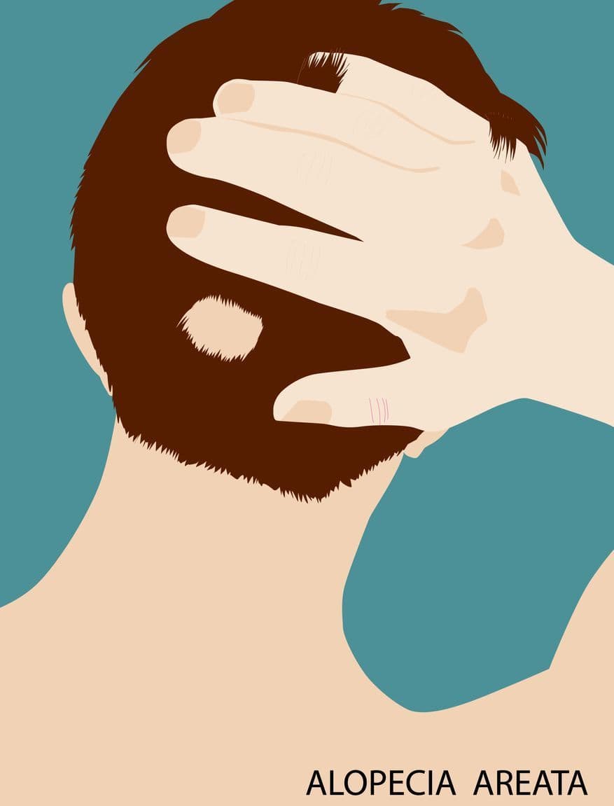 円形脱毛症イラスト