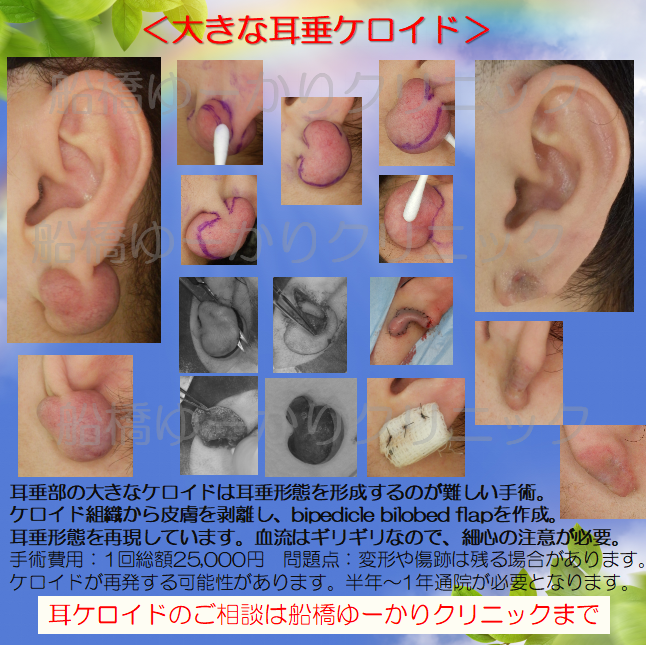 耳ケロイド摘出症例