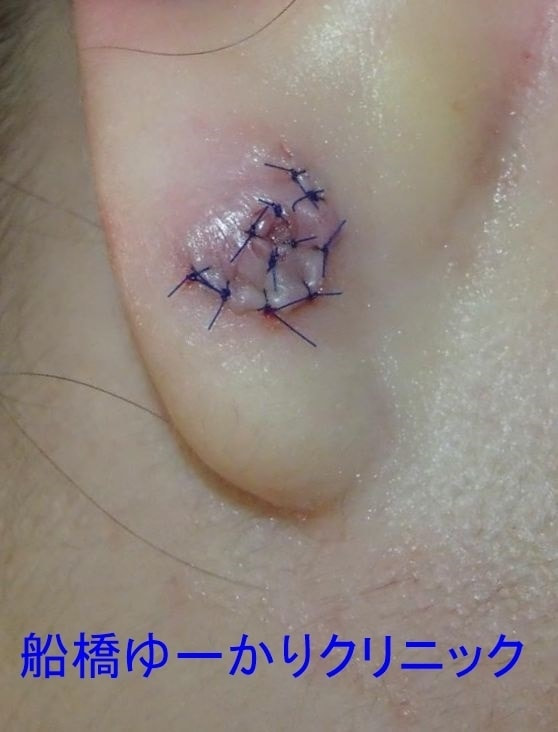 ピアス穴温存