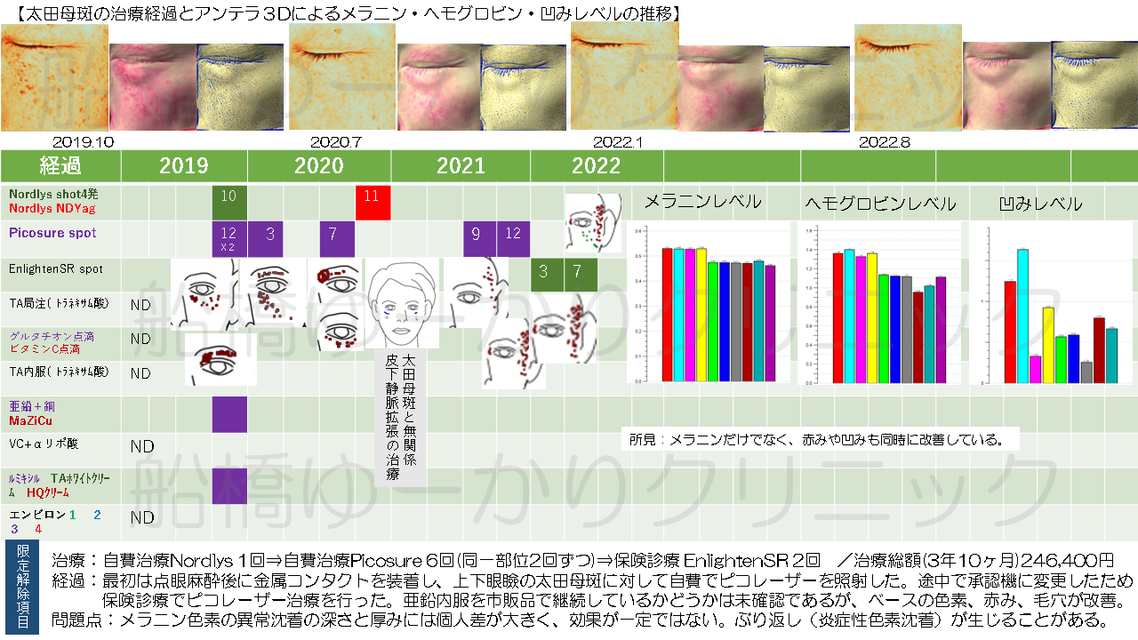 太田母斑治療例