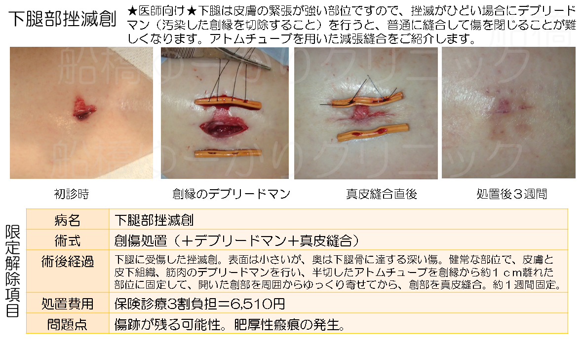 挫滅創症例２