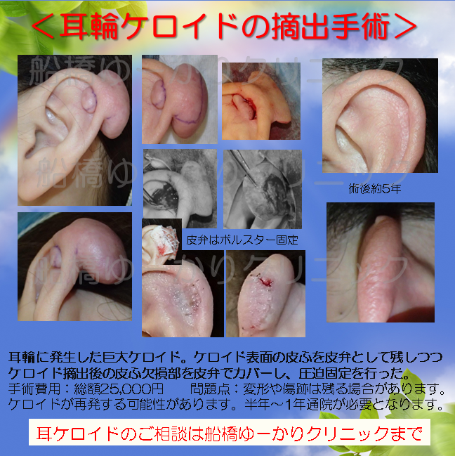 耳輪に発生した巨大ケロイド.左耳輪のケロイド除去を希望されて、ご来院。ケロイドは大きく、後方は3cm程度あった。治療内容.耳介腫瘍摘出術+皮弁形成術(保険診療).耳輪前後のケロイド組織を摘出+ケロイド表層の皮ふで皮弁形成。ボルスター固定。1週間後、抜糸。.治療頻度・治療期間.手術回数1回、通院回数7回.経過.直後は皮弁部が多少ぶ厚くなっていたが、ステロイド注射することなく、腫れは引いてきた。術後5年のフォローあり。手術費用. 手術の総額 25,000円.内訳.手術代 約20,000円.再診料,薬代など1,000円.予約料 4,000円.リスク・副作用.皮弁の創傷治癒の遅延による創部離開、皮弁壊死。傷跡が残る可能性。ケロイド再発の可能性。術後の定期的な通院の必要性。