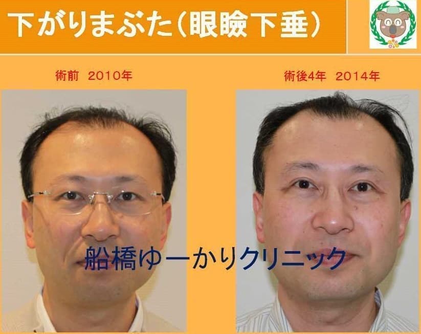 眼瞼下垂自験例