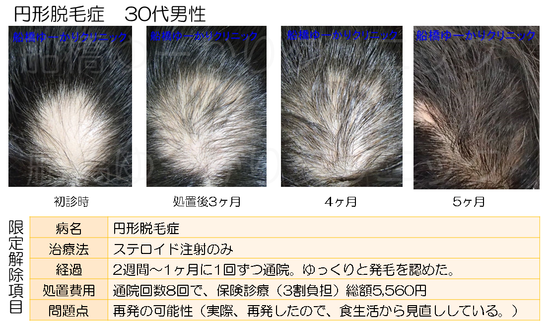 円形脱毛治療症例