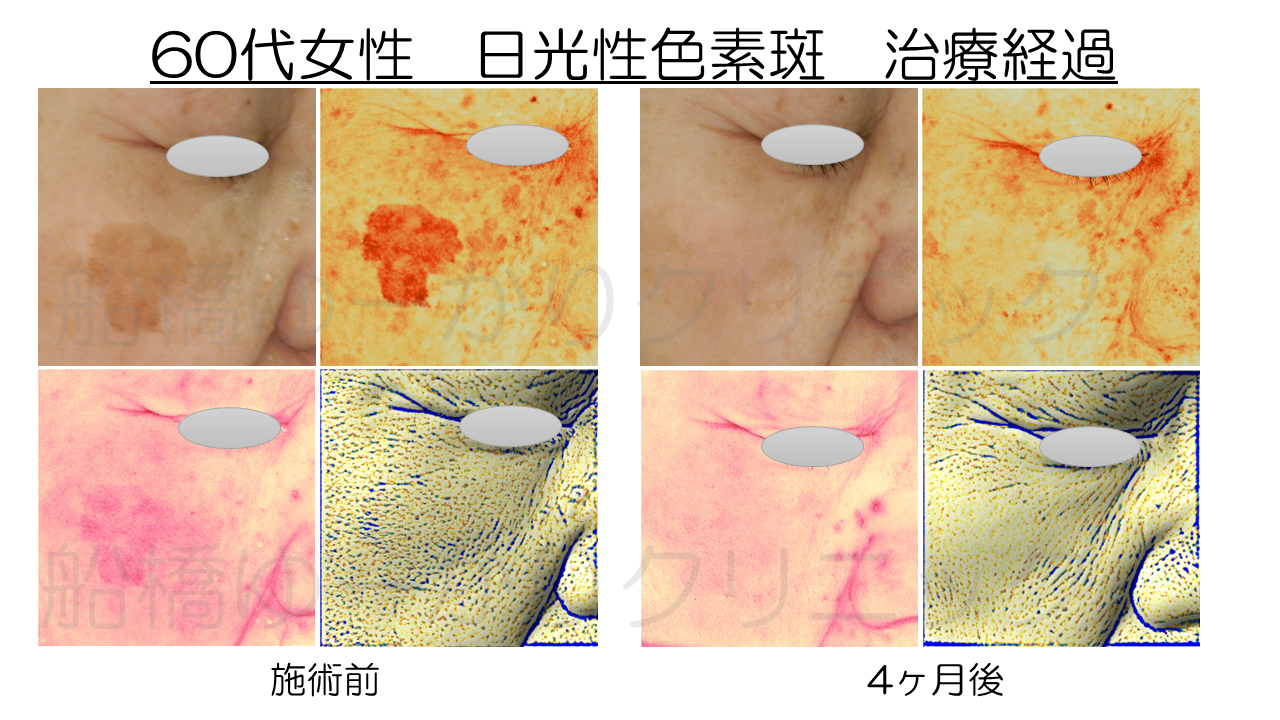 シミ治療症例２