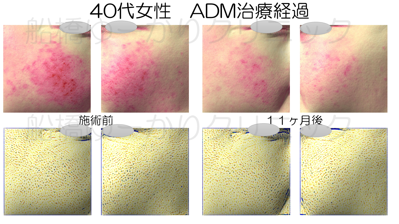 シミ治療症例３