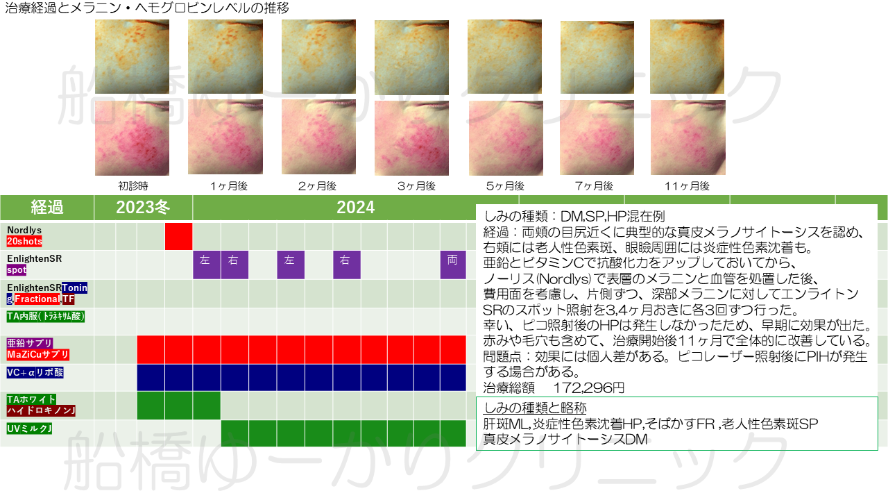 シミ治療症例３