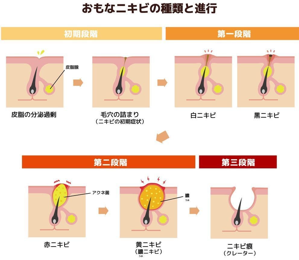 ニキビの段階イラスト