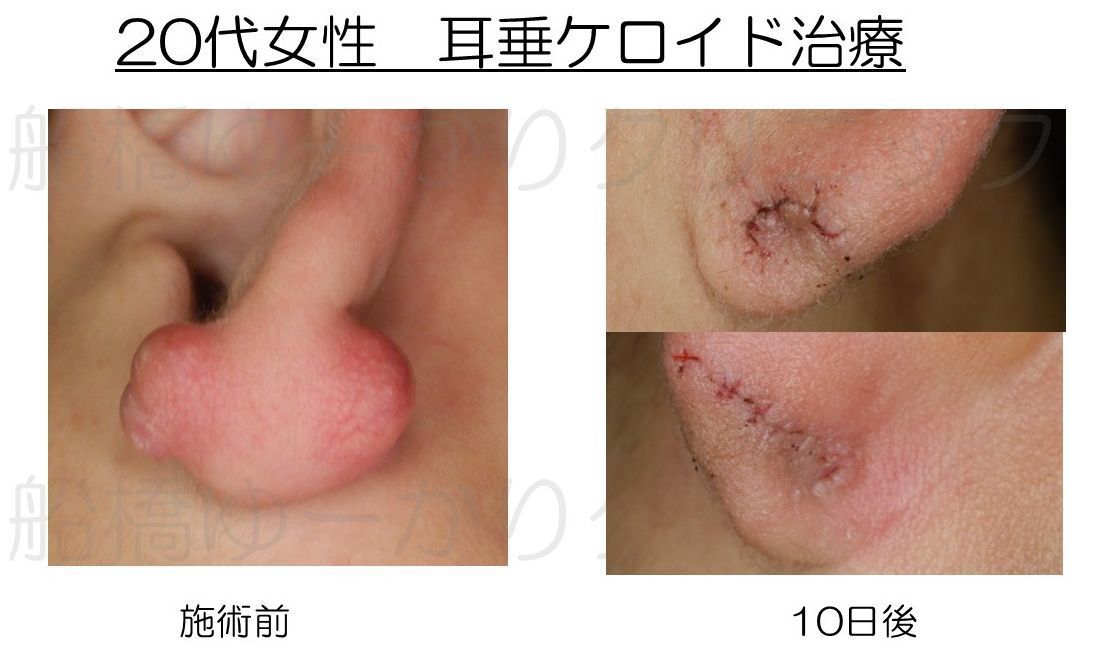 耳ケロイド摘出症例