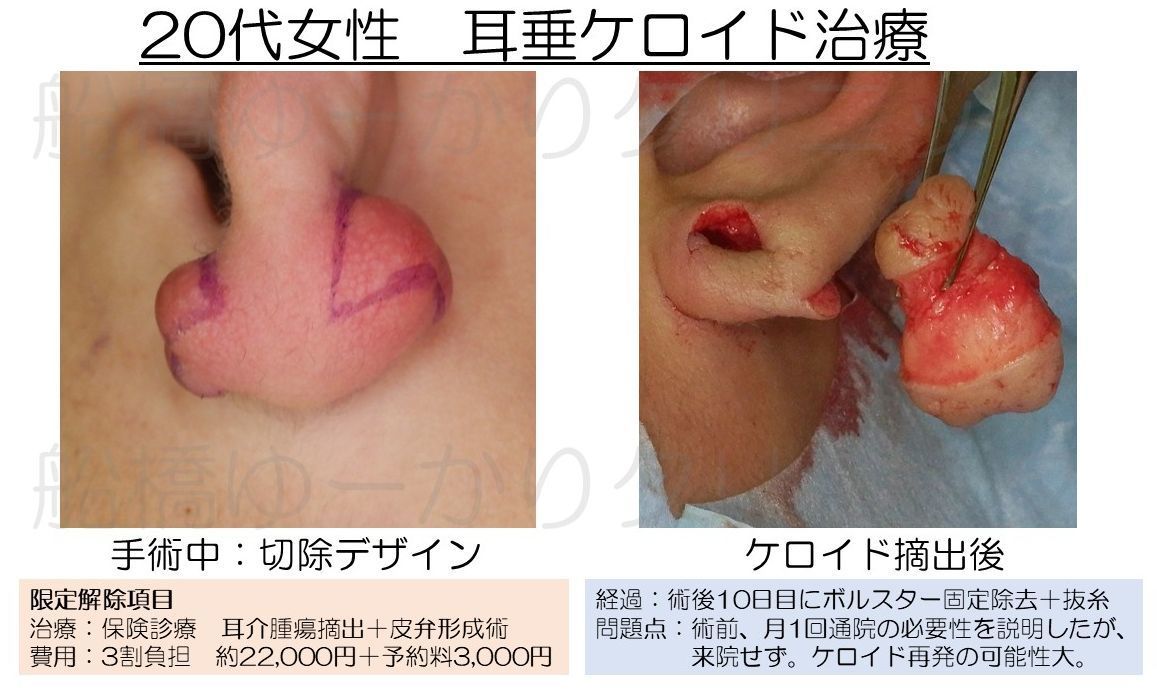耳ケロイド摘出症例
