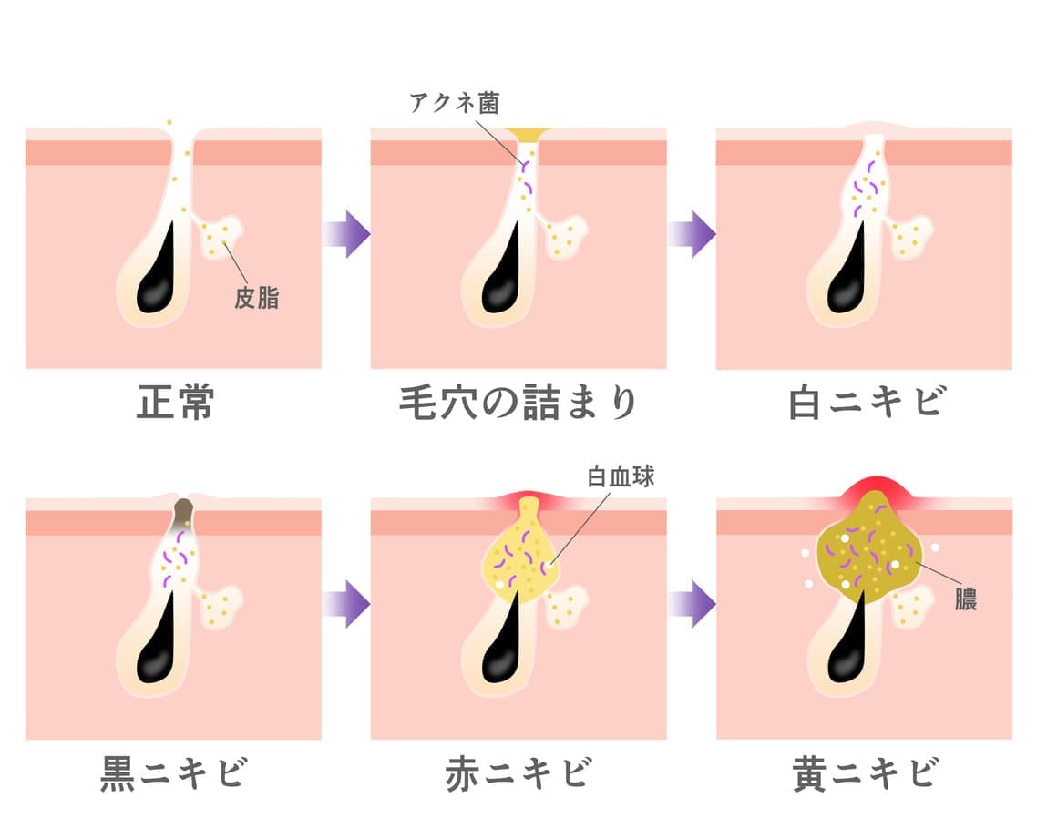 にきびイラスト