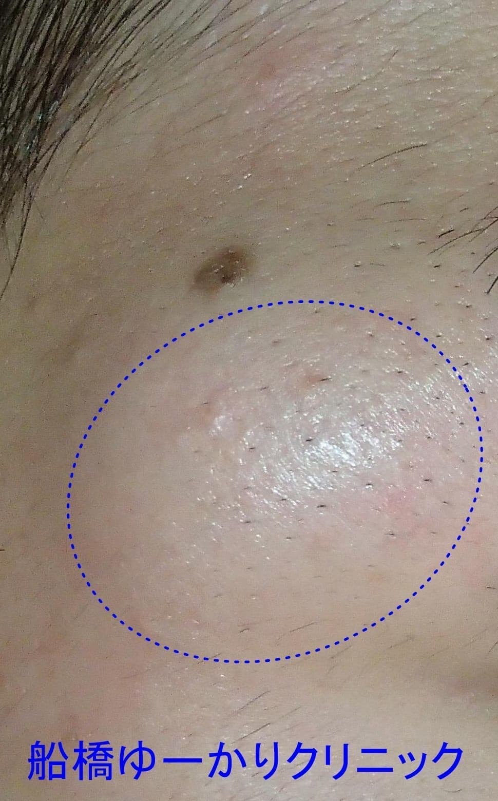 デルモイドシスト