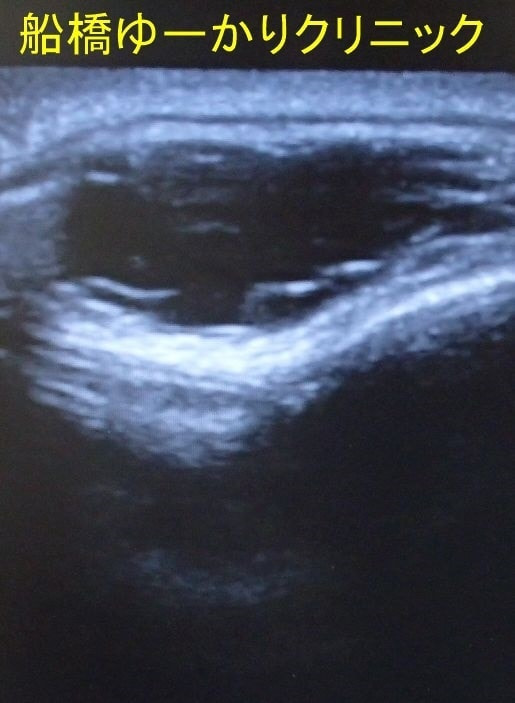 デルモイドシスト