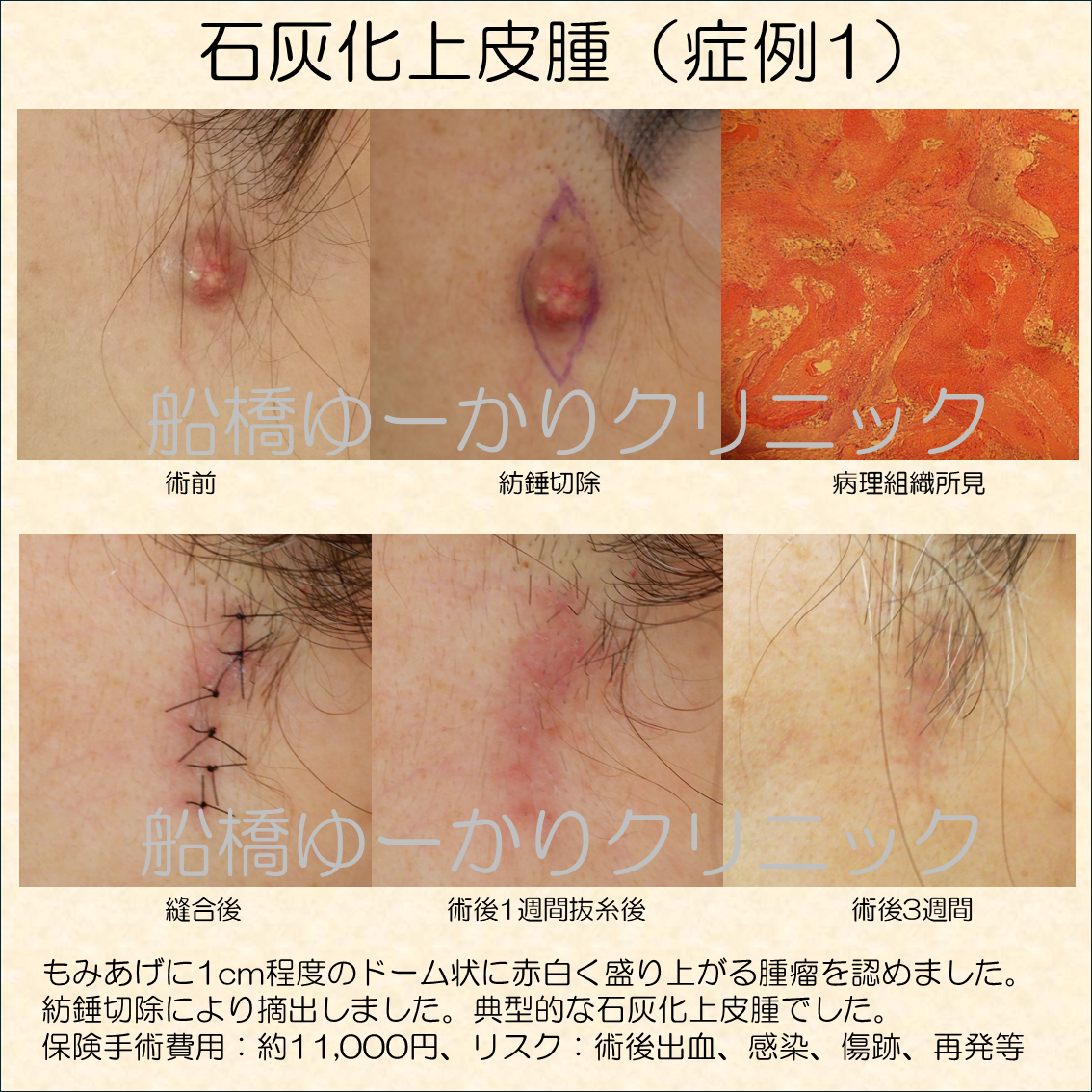 石灰化上皮腫写真