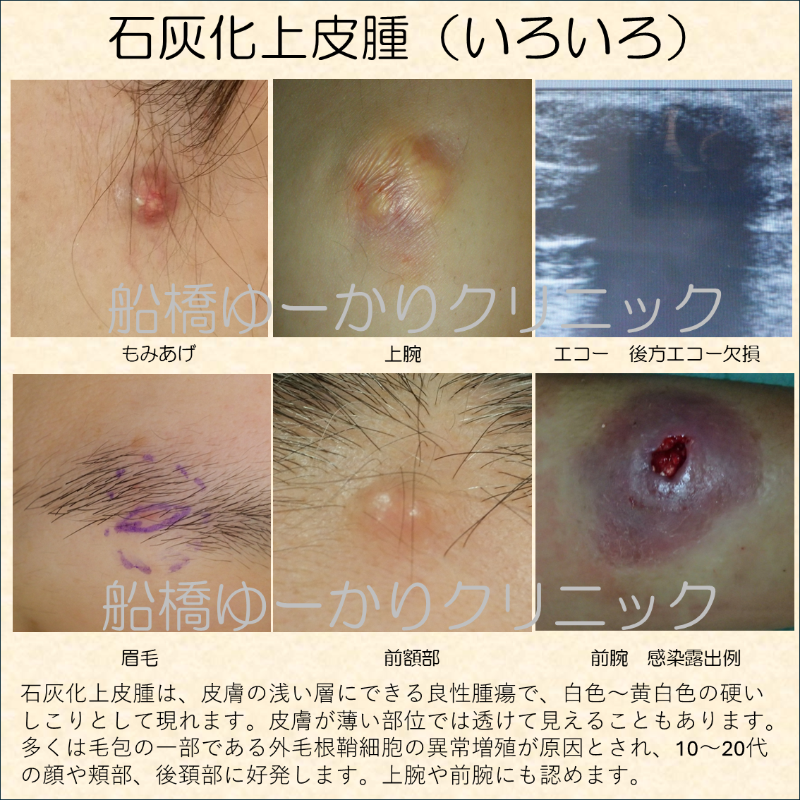 石灰化上皮腫は、皮膚の浅い層にできる良性腫瘍で、白色~黄白色の硬いしこりとして現れます。皮膚が薄い部位では透けて見えることもあります。多くは毛包の一部である外毛根鞘細胞の異常増殖が原因とされ、10〜20代の顔や頬部、後頚部に好発します。上腕や前腕にも認めます。