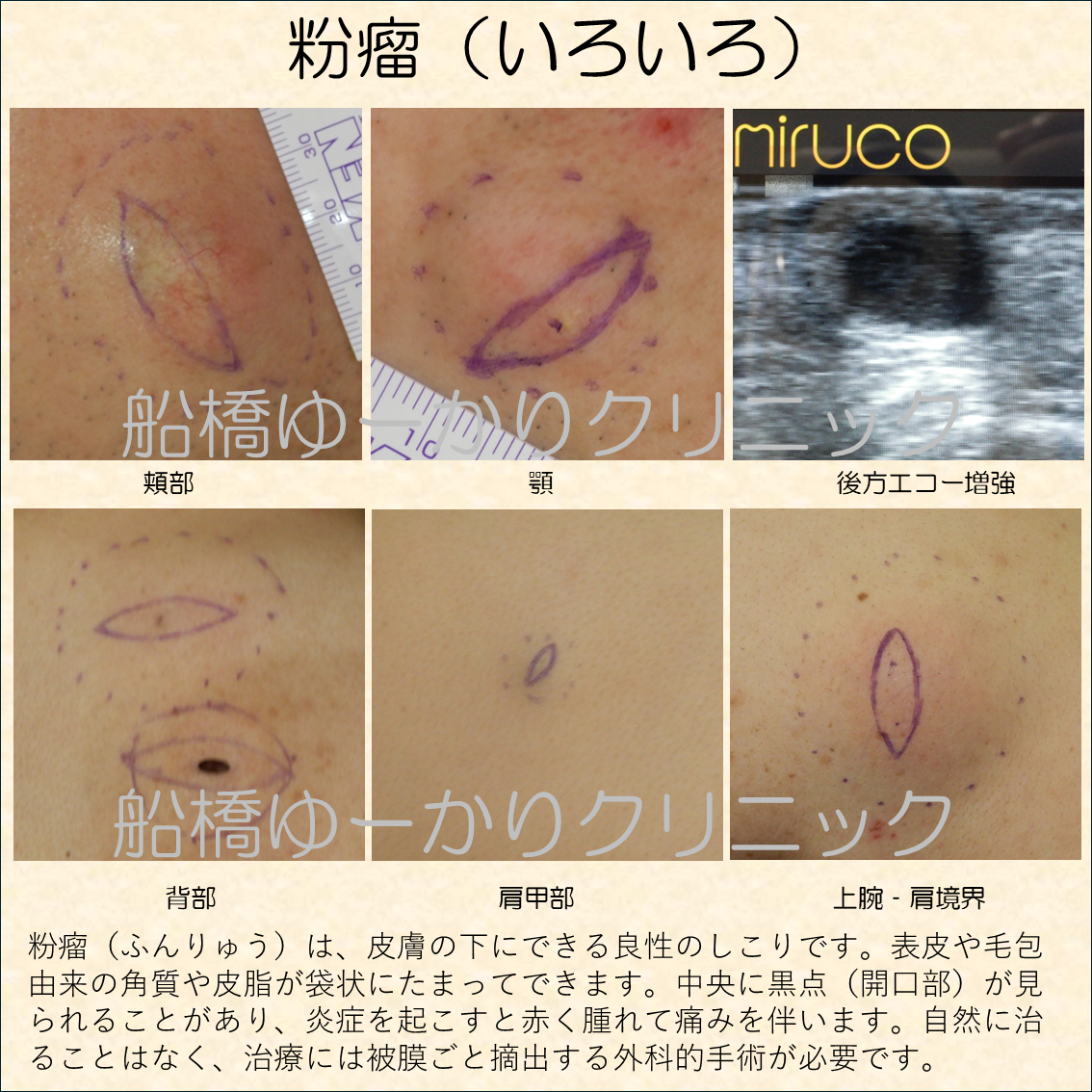 粉瘤(ふんりゅう)は、皮膚の下にできる良性のしこりです。表皮や毛包由来の角質や皮脂が袋状にたまってできます。中央に黒点(開口部)が見られることがあり、炎症を起こすと赤く腫れて痛みを伴います。自然に治ることはなく、治療には被膜ごと摘出する外科的手術が必要です。