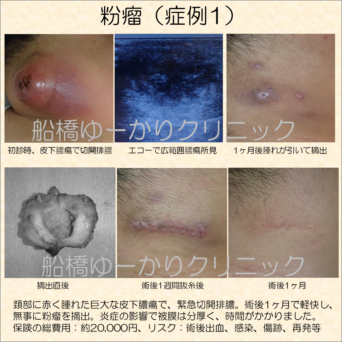 頚部に赤く腫れた巨大な皮下膿瘍で、緊急切開排膿。術後1ヶ月で軽快し、 無事に粉瘤を摘出。炎症の影響で被膜は分厚く、時間がかかりました。 保険の総費用:約20,000円、リスク:術後出血、感染、傷跡、再発等