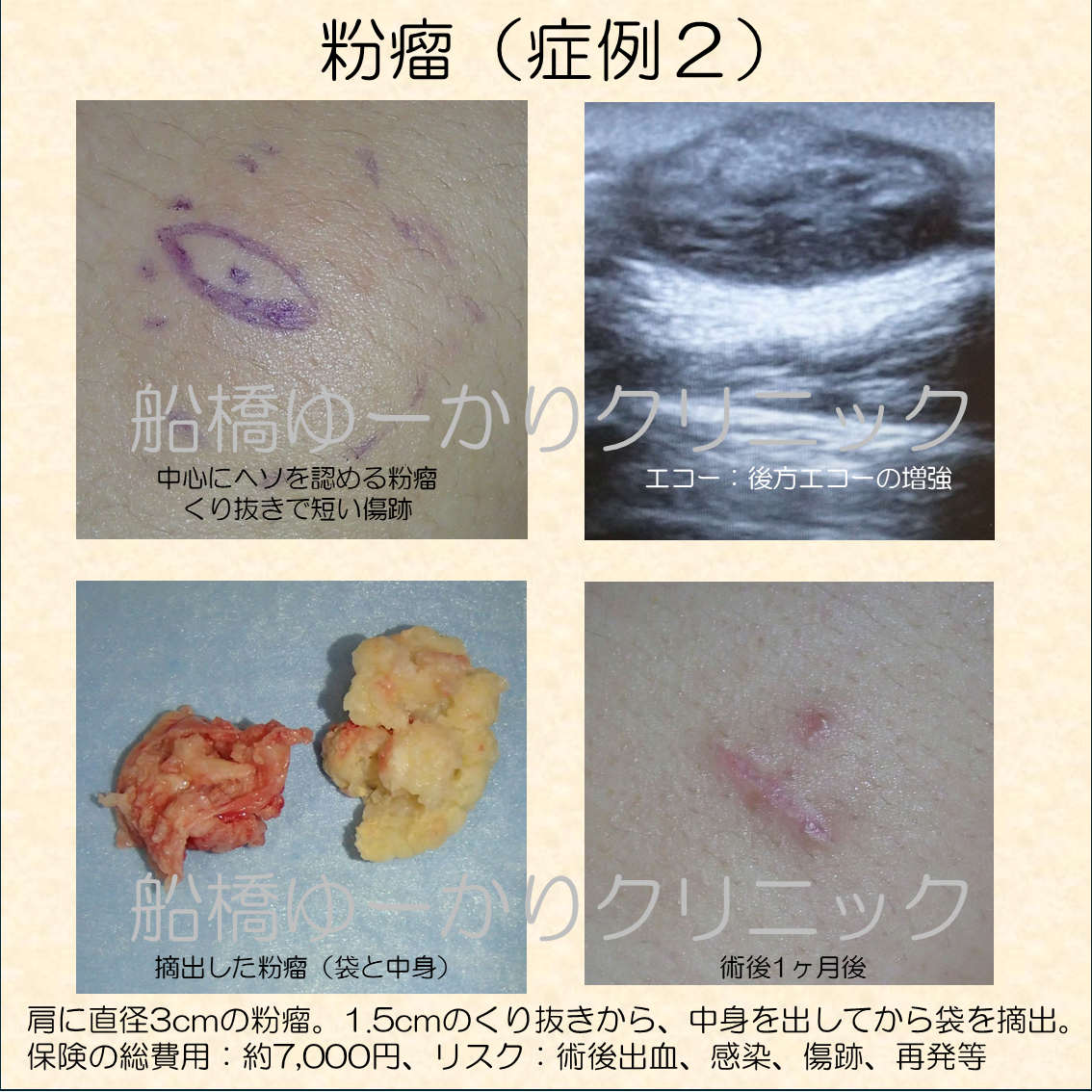 肩に直径3cmの粉瘤。1.5cmのくり抜きから、中身を出してから袋を摘出。 保険の総費用:約7,000円、リスク:術後出血、感染、傷跡、再発等