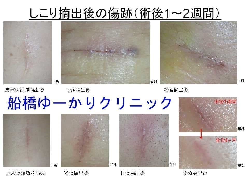 術後傷跡