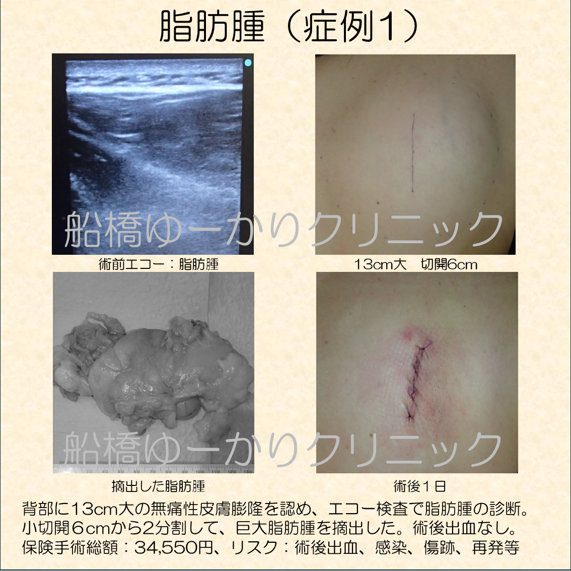 背部に13cm大の無痛性皮膚膨隆を認め、エコー検査で脂肪腫の診断。 小切開６cmから2分割して、巨大脂肪腫を摘出した。術後出血なし。 保険手術総額：34,550円、リスク：術後出血、感染、傷跡、再発等