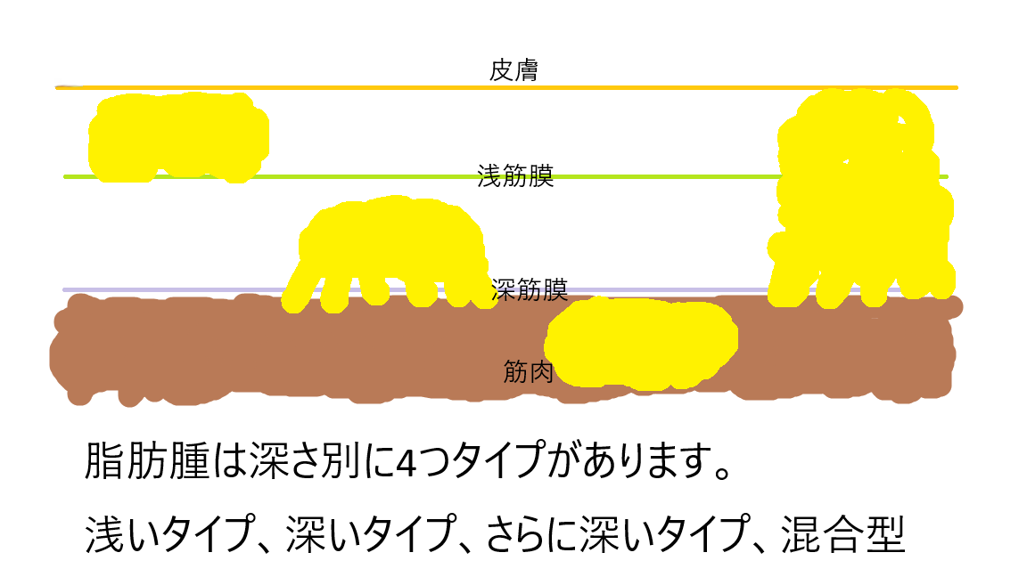 脂肪腫の深さ