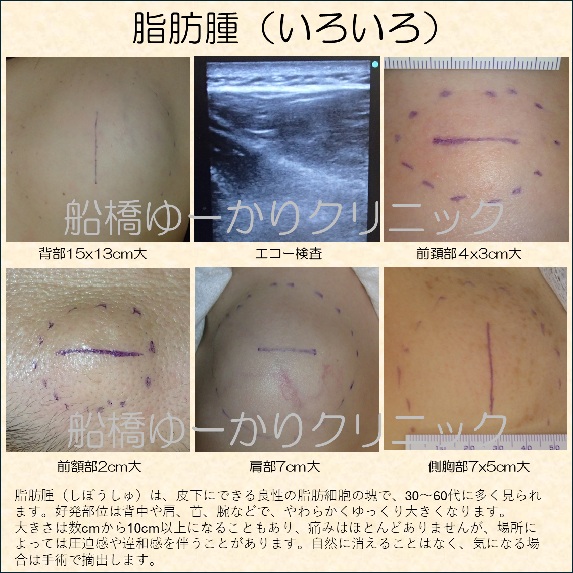 脂肪腫いろいろ