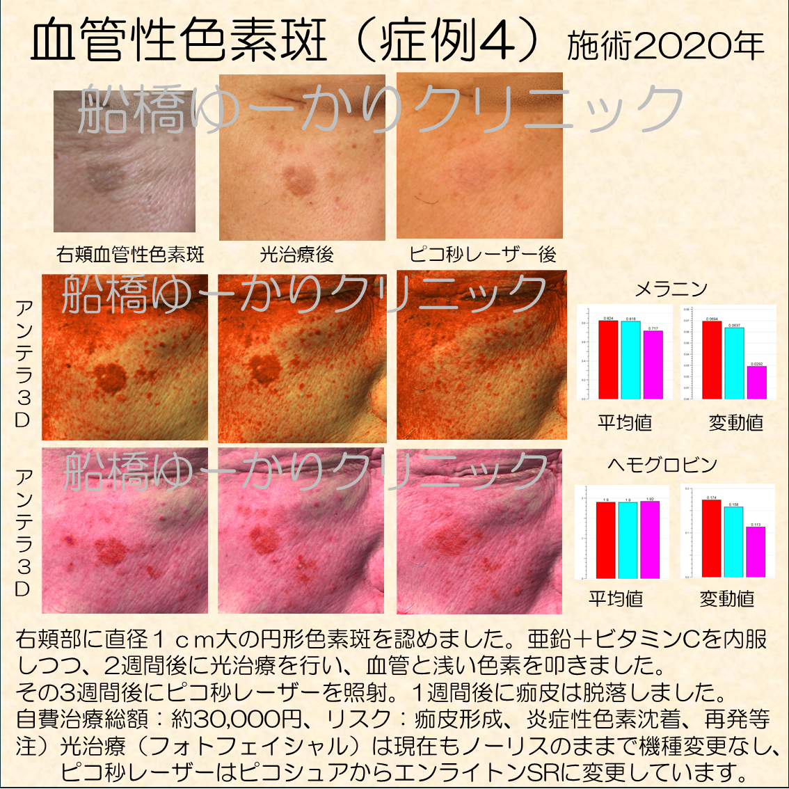 血管性色素斑治療