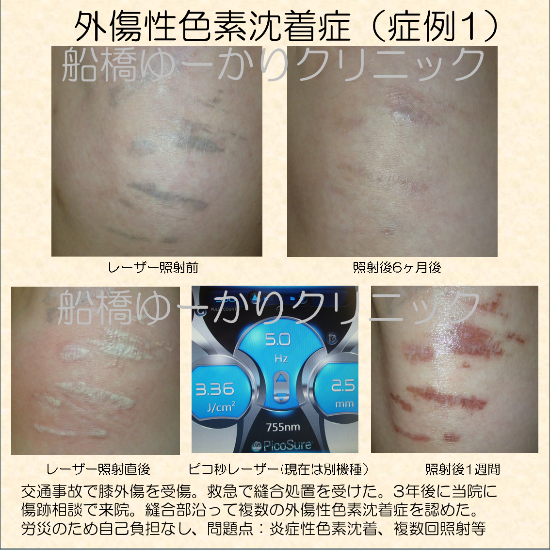 外傷性色素沈着症レーザー治療