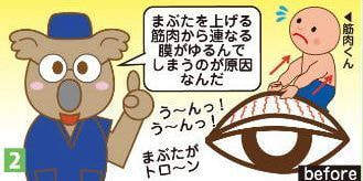 眼瞼下垂のメカニズム