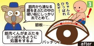 眼瞼下垂の手術
