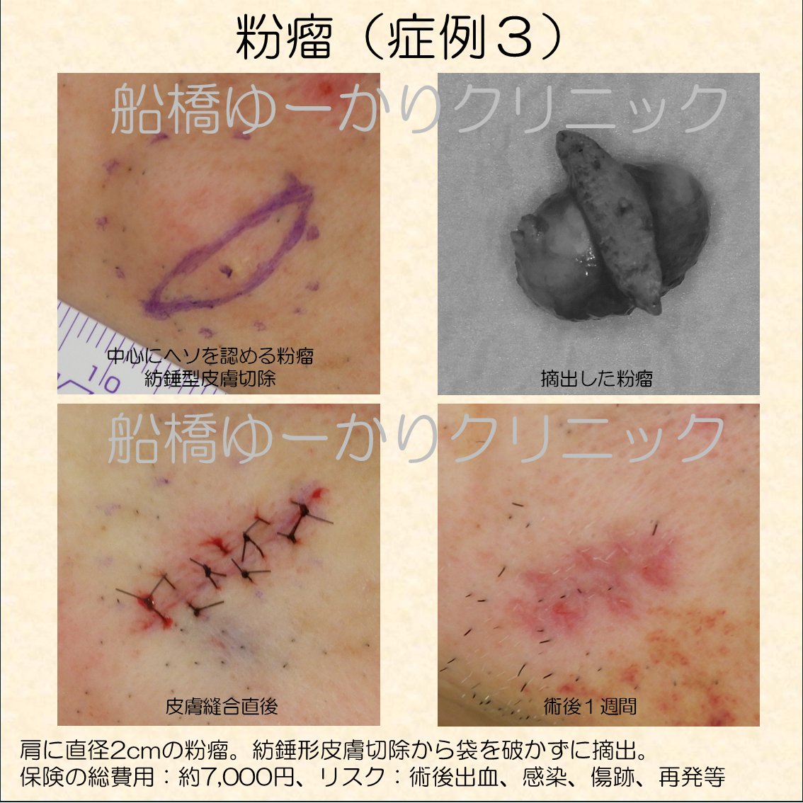 粉瘤摘出手術