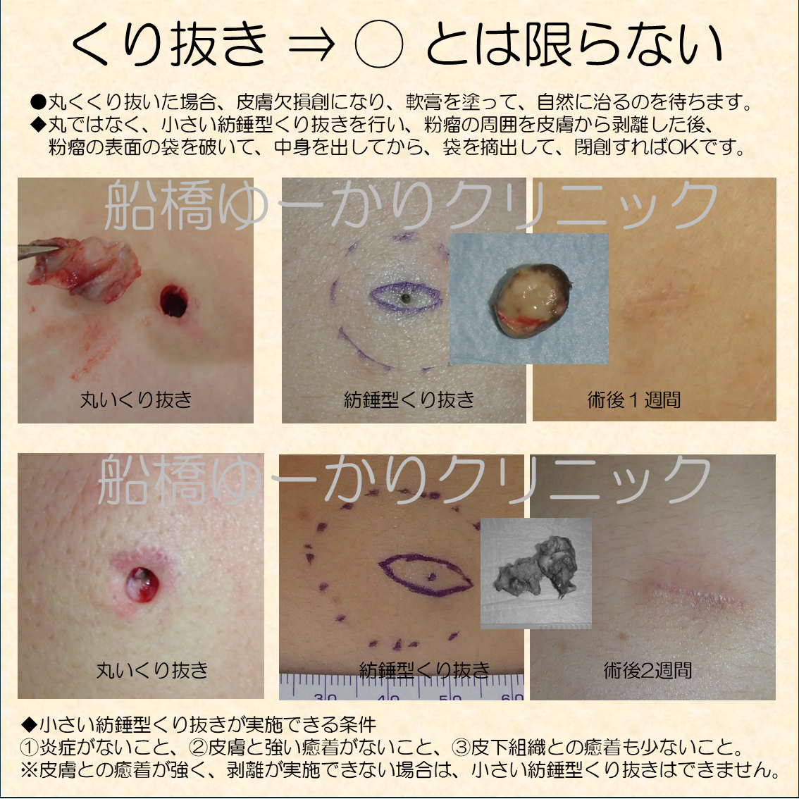 くり抜き摘出