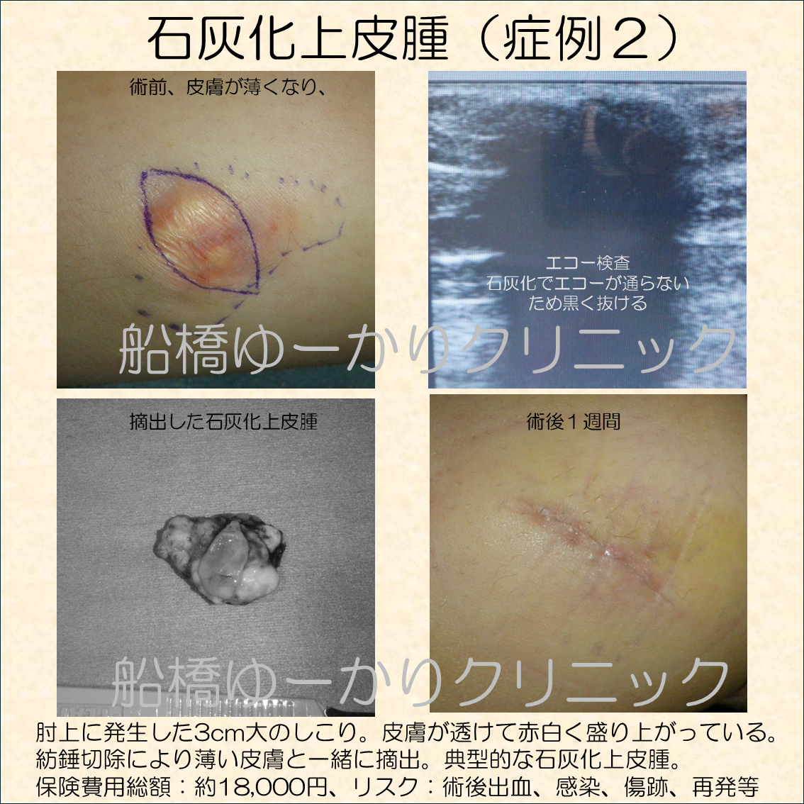 肘上に発生した3cm大のしこり。皮膚が透けて赤白く盛り上がっている。 紡錘切除により薄い皮膚と一緒に摘出。典型的な石灰化上皮腫。 保険手術費用：約11,000円、リスク：術後出血、感染、傷跡、再発等