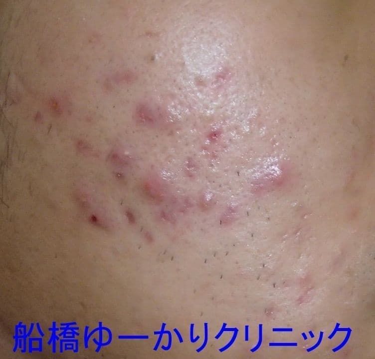 ニキビ治療前