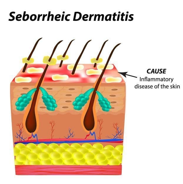 脂漏性皮膚炎イラスト