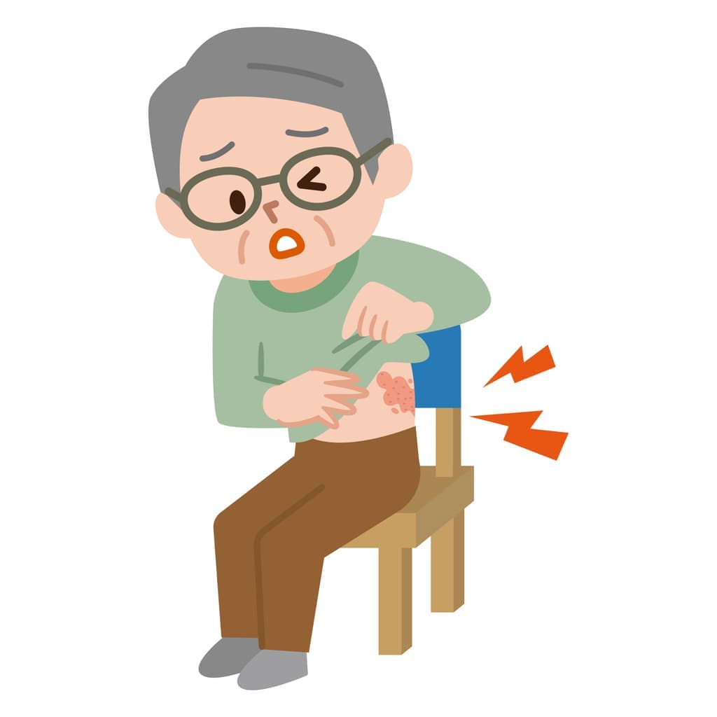 帯状疱疹イラスト