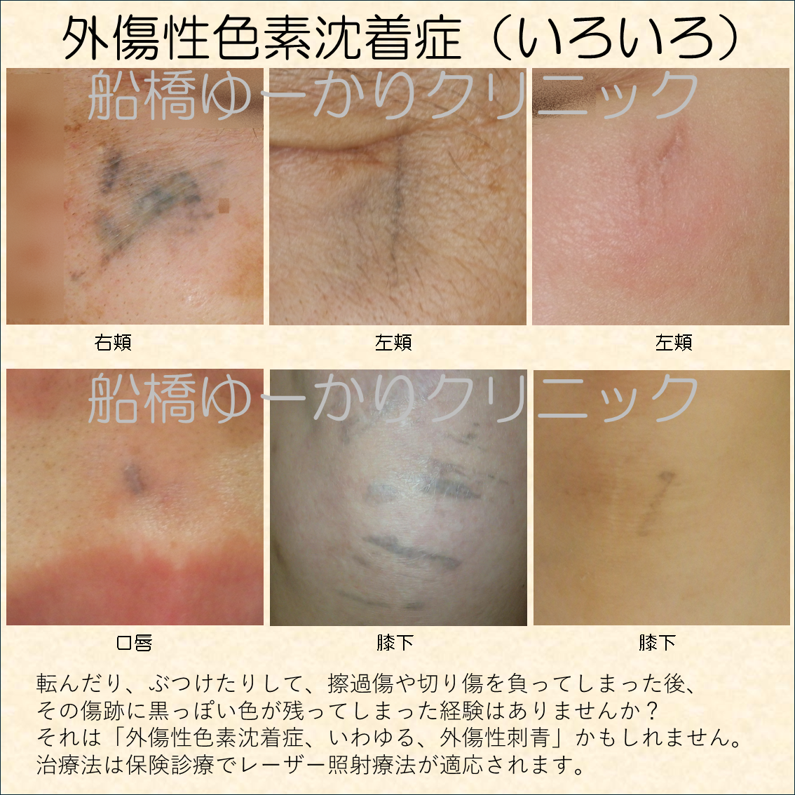 外傷性色素沈着症いろいろ