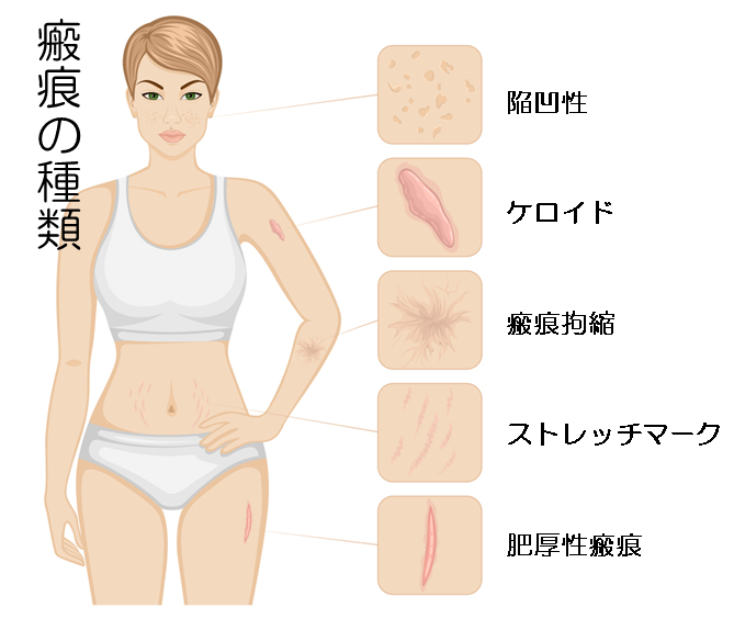 ケロイド・肥厚性瘢痕イラスト