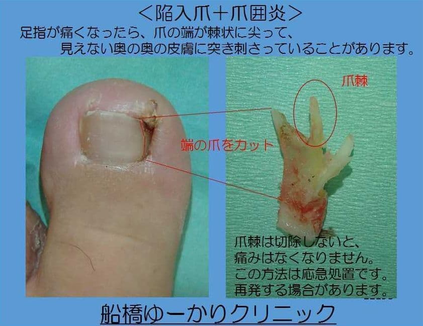 陥入爪の原因となる爪棘