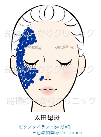 太田母斑の分布イメージ