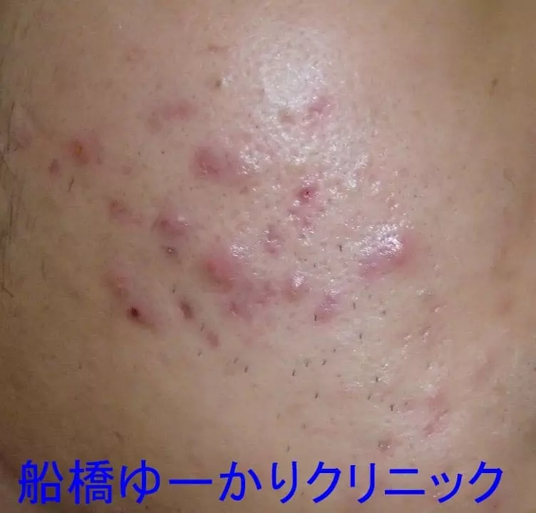 ニキビ治療前