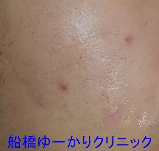 ニキビ治療後