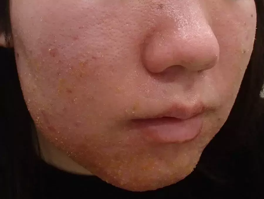 ベピオ使用時の皮膚反応例