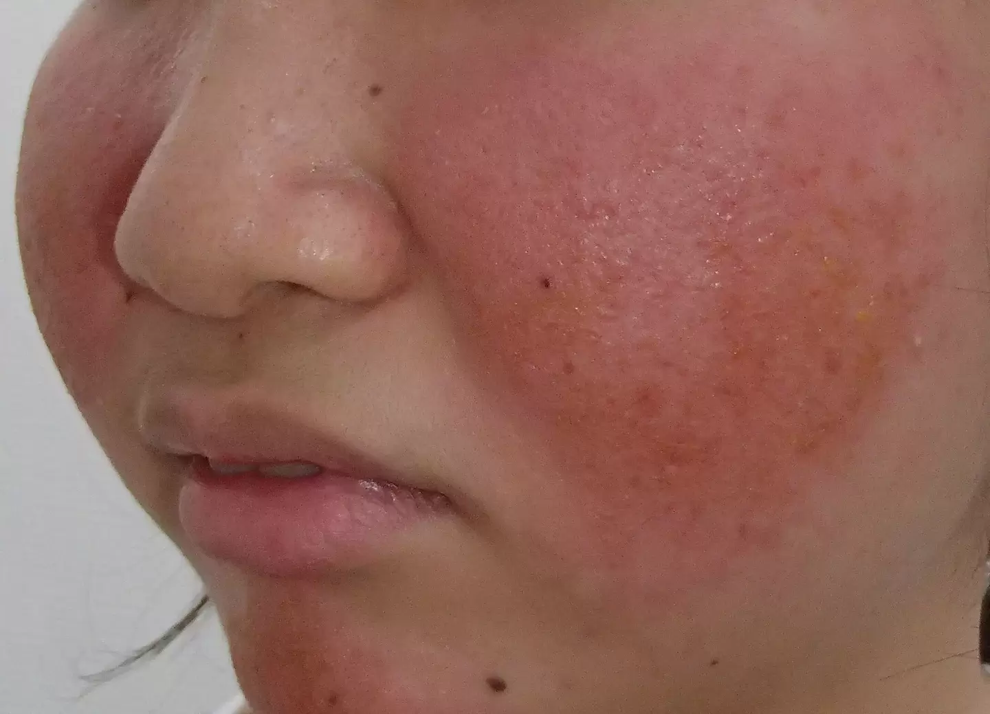 ベピオ使用時の皮膚反応例