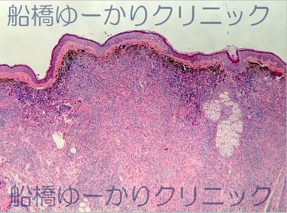 母斑細胞とメラニンの模式図