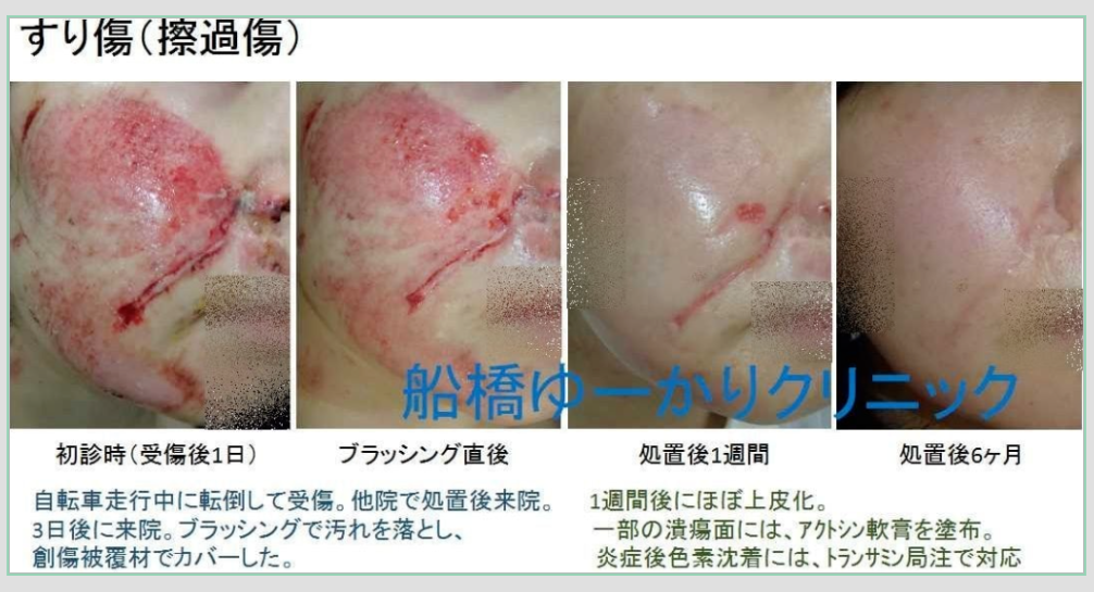 擦過傷治療症例1