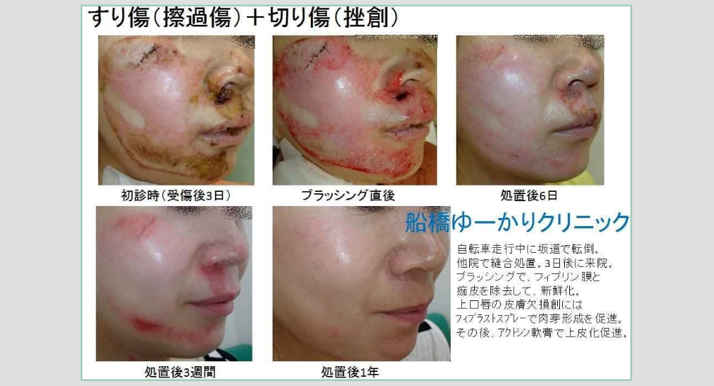 擦過傷治療症例2